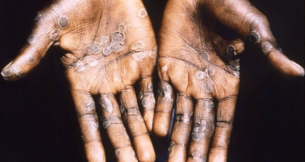 The palms of a patient with skin lesions due to monkeypox